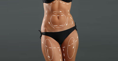 How Liposuction Surgery is Performed in India